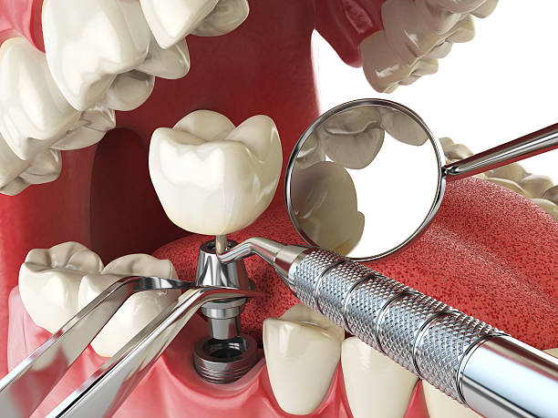 Best Emergency Root Canal Treatment in Darmstadt, IN